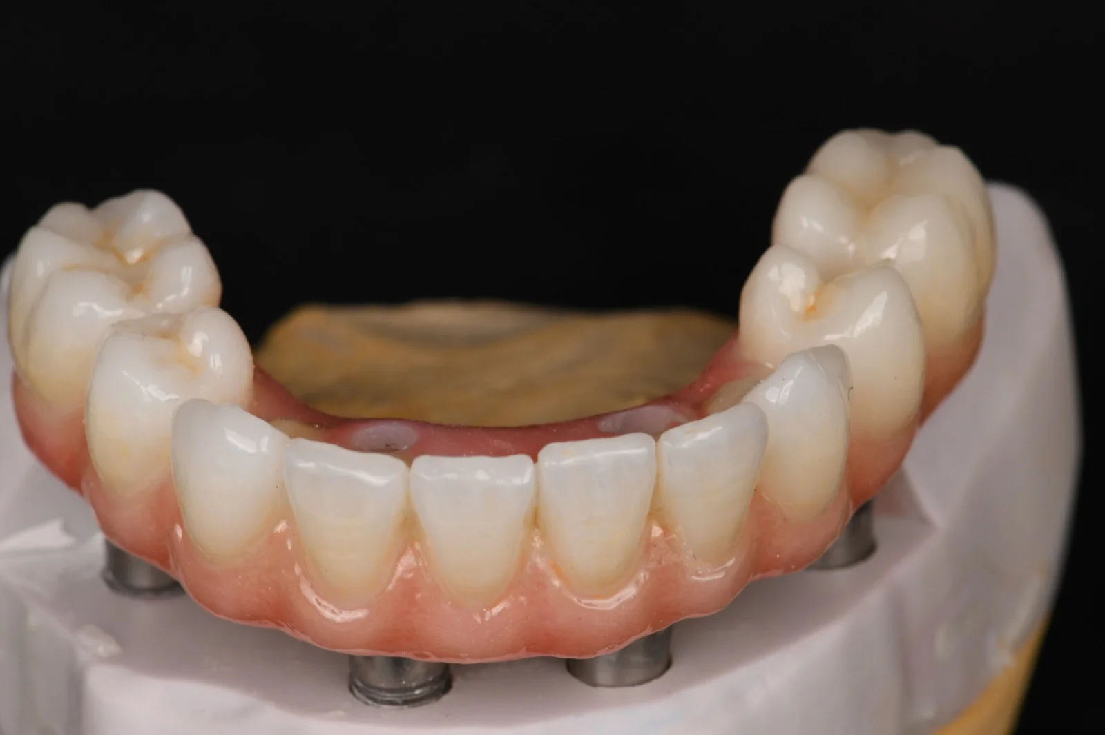 All on 4 Zirconia on Ti-Bases with Porcelain Build Up 3