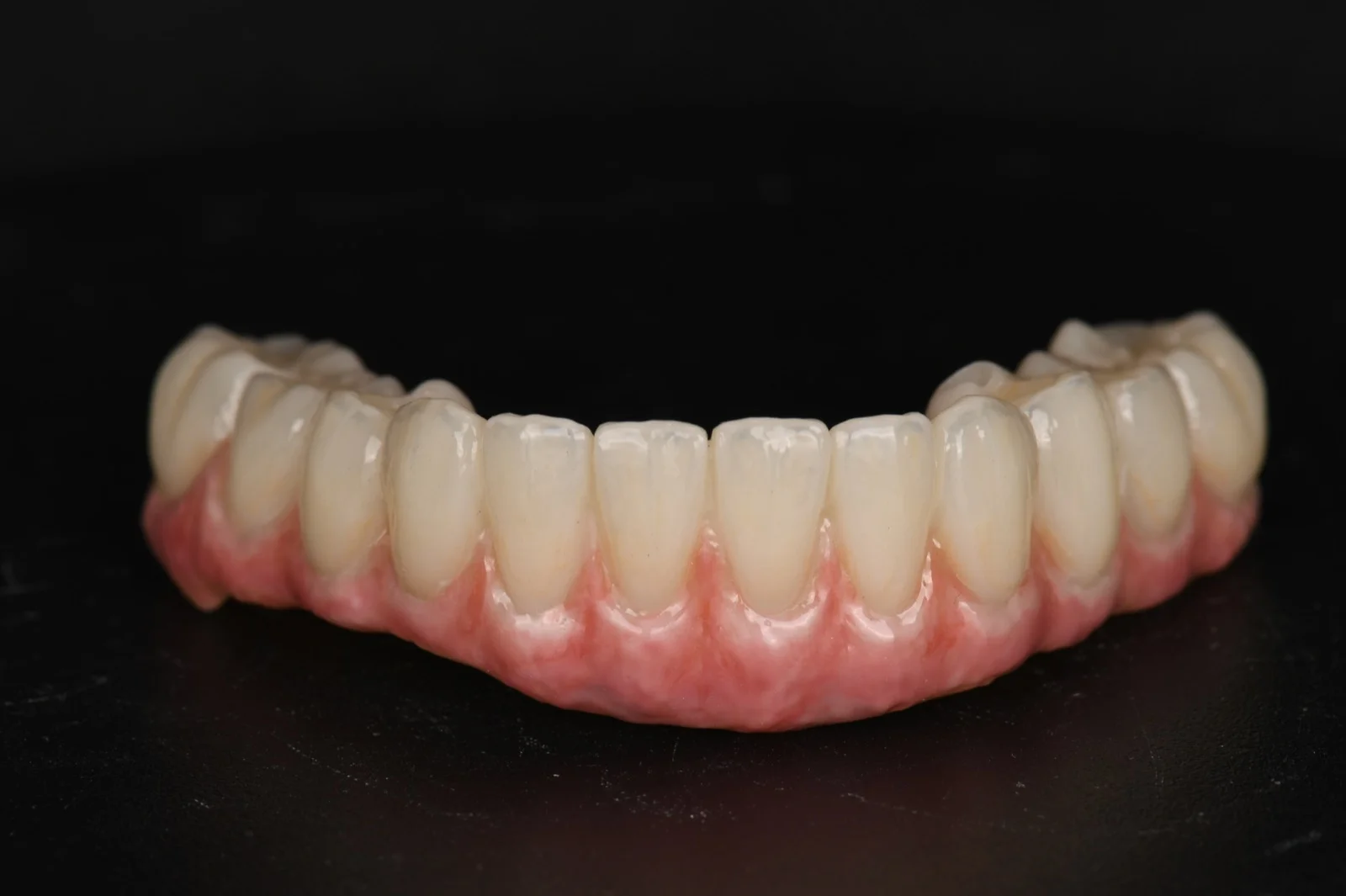 All on X Zirconia on Ti Bar – Lower Arch 1