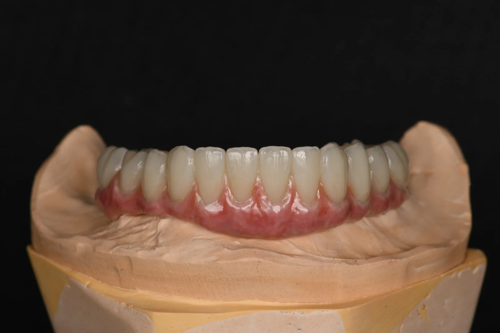All on X Zirconia on Ti Bar – Lower Arch 3