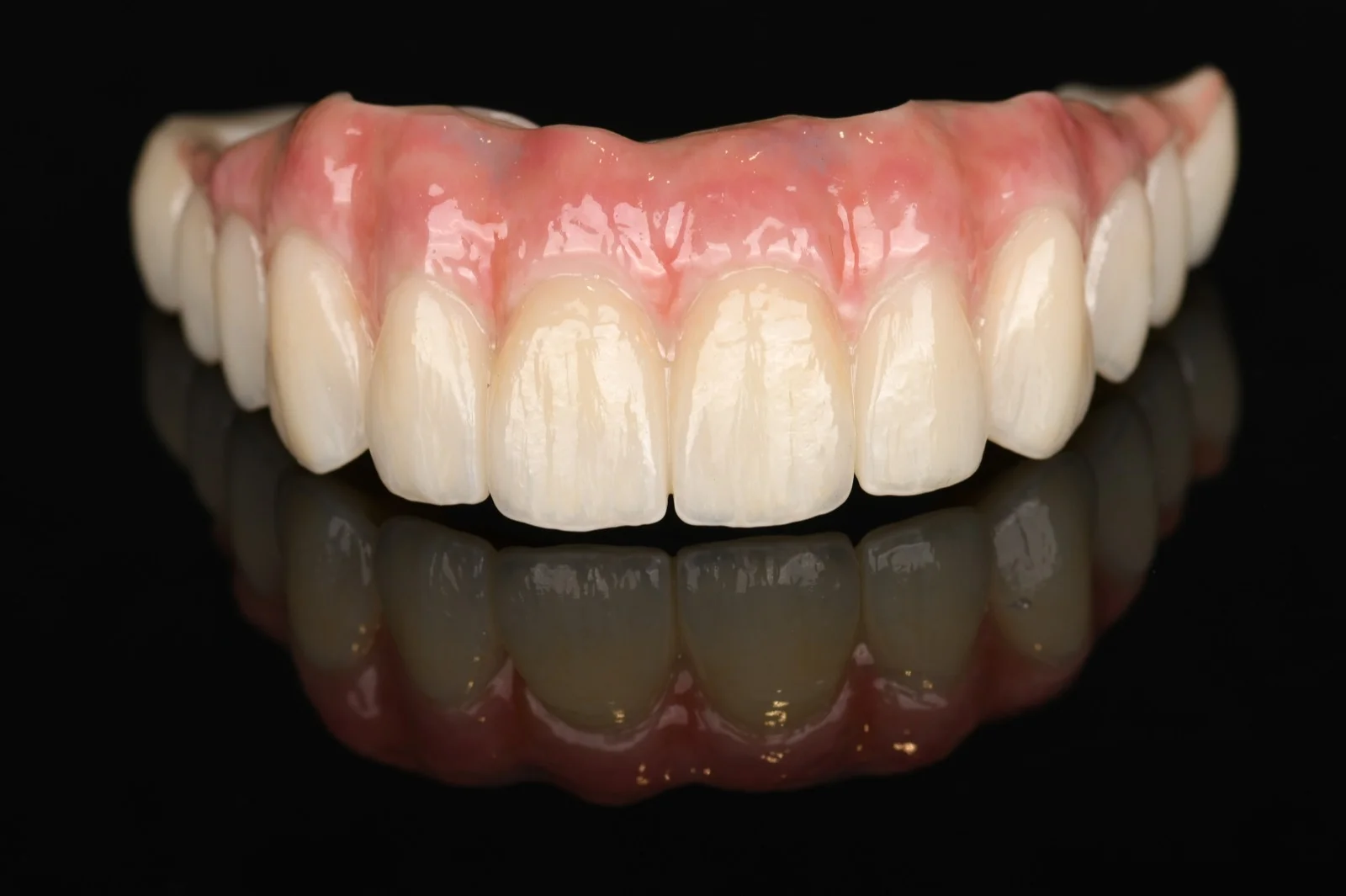 All on X Zirconia on Ti Bar – Upper Arch 1