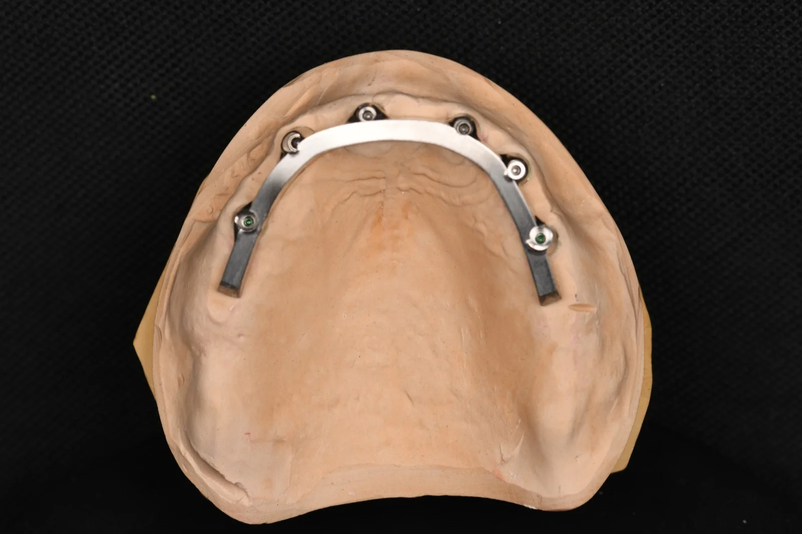 All on X Zirconia on Ti Bar – Upper Arch 2