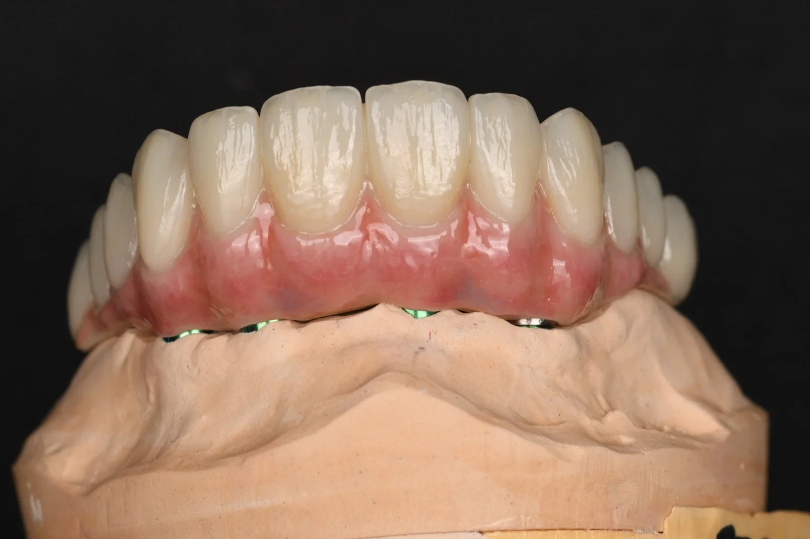 All on X Zirconia on Ti Bar – Upper Arch 3