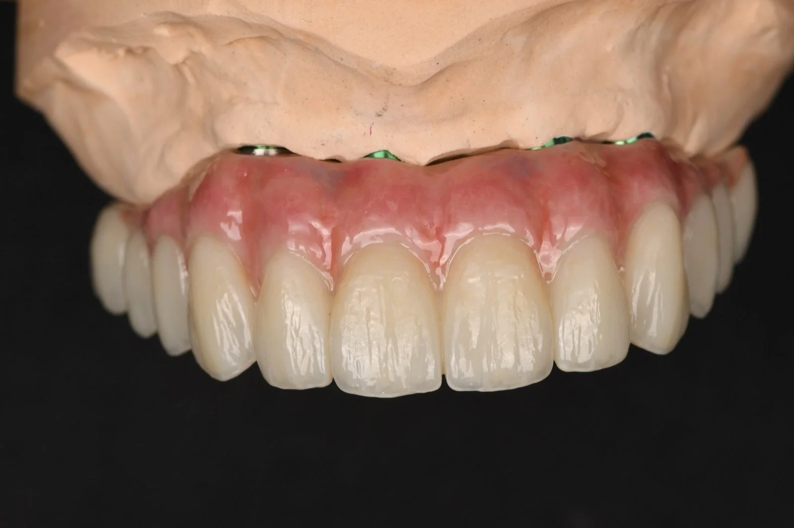 All on X Zirconia on Ti Bar – Upper Arch 4