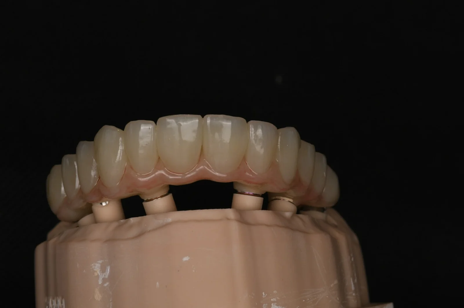 Full Mouth Rehabilitation 1