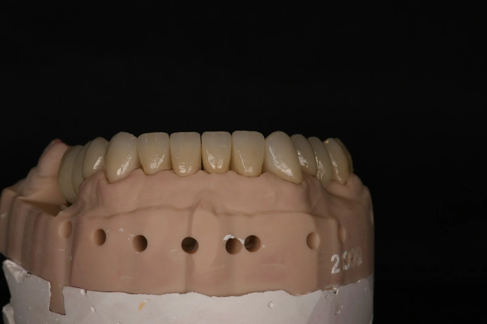 Full Mouth Rehabilitation 2