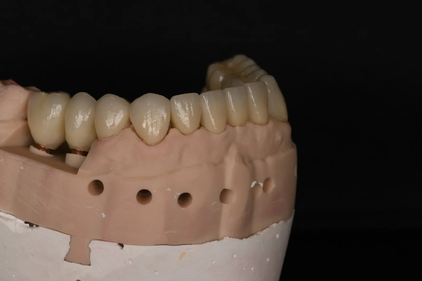 Full Mouth Rehabilitation 3