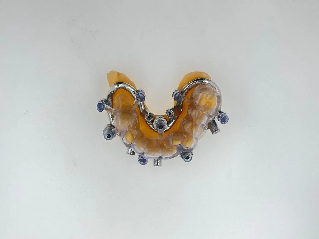 Guided Surgery with Temporary 4