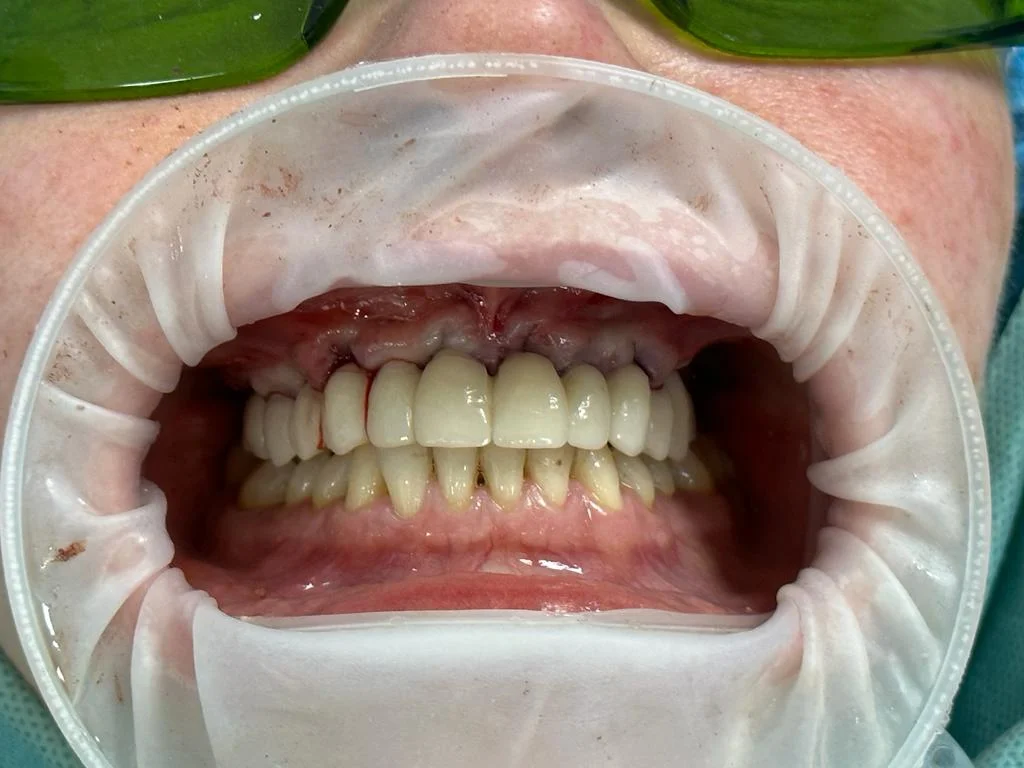 Guided Surgery with Temporary 6