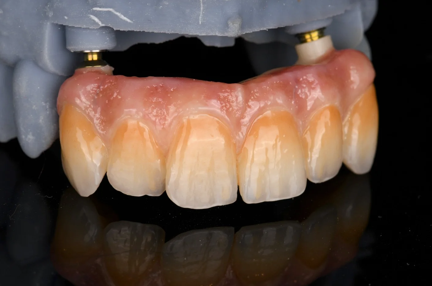 Screw Retained Zirconia Bridge on Two Implants 1
