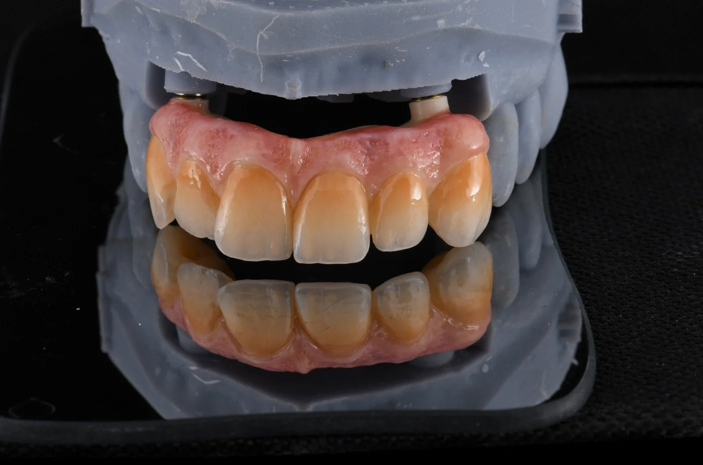 Screw Retained Zirconia Bridge on Two Implants 2