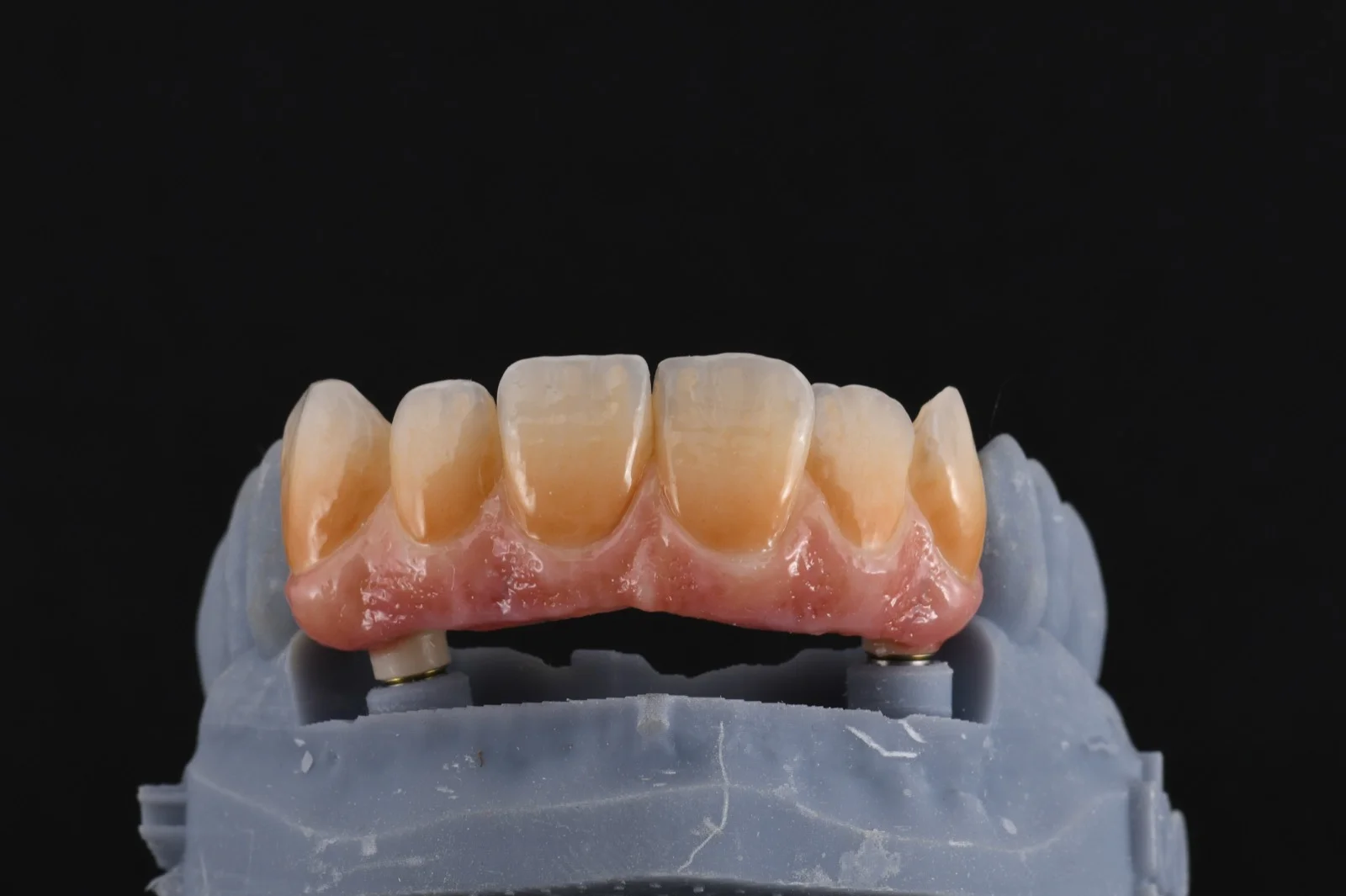 Screw Retained Zirconia Bridge on Two Implants 3